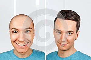 Bald guy before and after transplant hair and alopecia