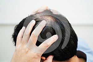 Bald head in man, hair loss treatment health problem