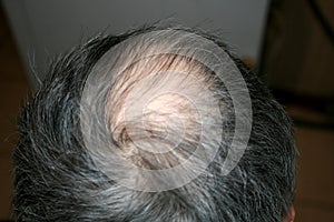 Bald head of a man. Receding hairline.
