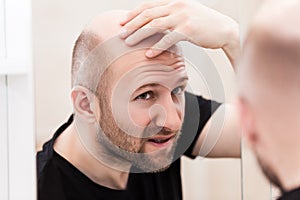 Bald man looking mirror at head baldness and hair loss