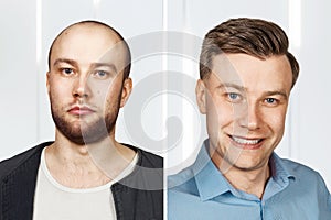 Bald Man before and after transplant hair and alopecia