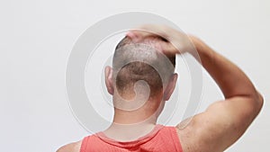 Bald man using hair restorer