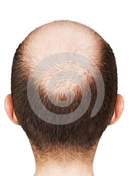 Bald men head