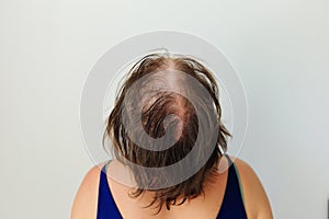 Bald patches of total alopecia of a woman
