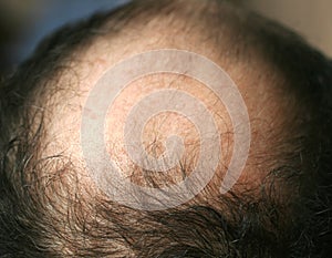 A bald spot on a man`s head. Alopecia. Hair loss