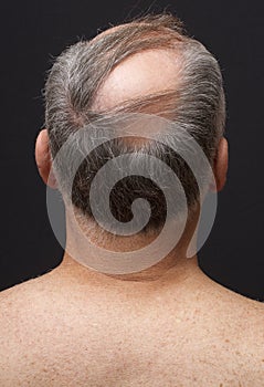 Balding Man's Head