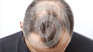 Balding young man, Hair loss problem