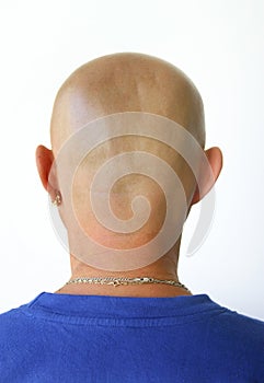 Baldness