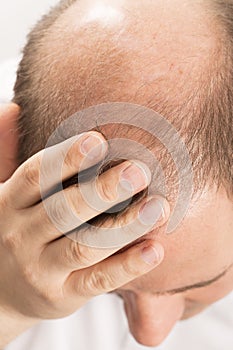 Baldness Alopecia man hair loss