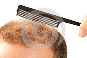 Baldness Alopecia man hair loss
