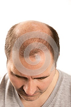 Baldness Alopecia man hair loss haircare