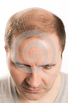 Baldness Alopecia man hair loss haircare