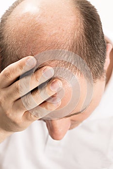 Baldness Alopecia man hair loss haircare