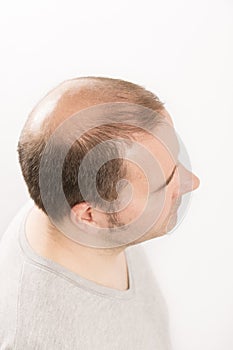 Baldness Alopecia man hair loss haircare