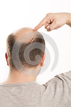 Baldness Alopecia man hair loss haircare