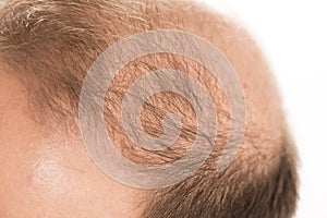 Baldness Alopecia man hair loss haircare