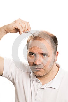 Baldness Alopecia man hair loss isolated