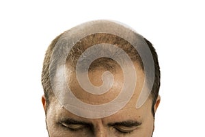 Baldness Alopecia man hair loss isolated