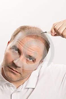 Baldness Alopecia man hair loss isolated