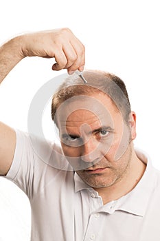 Baldness Alopecia man hair loss isolated