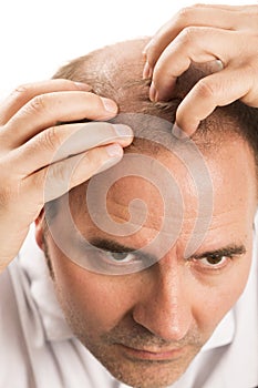 Baldness Alopecia man hair loss isolated