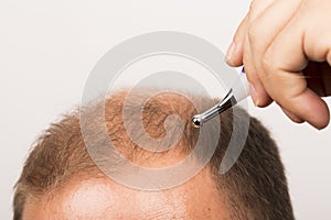 Baldness Alopecia man hair loss isolated