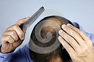 Baldness, man combing his head with a comb