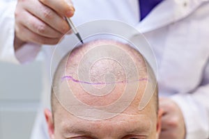 Baldness treatment. Patient suffering from hair loss in consultation with a doctor. Preparation for hair transplant