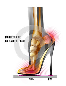 Ball of foot pain high heel shoe bones weight distribution. X ray skeleton realistic anatomy illustration