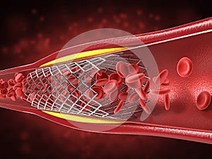 Balloon angioplasty procedure