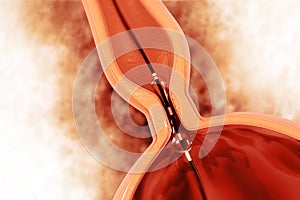 Balloon angioplasty procedure with stent in vein