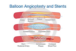 Balloon angioplasty and stents procedure