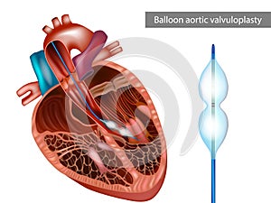 Balloon aortic valvuloplasty or BAV. The balloon catheter is advanced. Aortic stenosis, or narrowing of the aortic valve photo