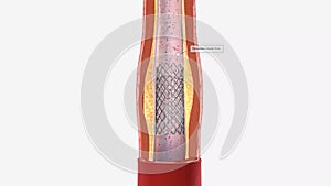 The balloon catheter expands the stent which widens the carotid artery.