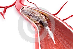 Balloon Expandable Stent