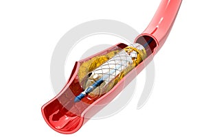 Balloon Expandable Stent