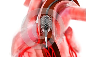 Balloon Expandable Stent. Anatomical concept