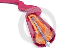 Balloon Expandable Stent