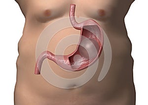 Balloon gastric. inflatable device that is placed in the stomach to reduce weight