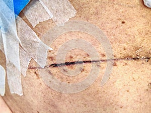 Bandage of fresh scar on the abdomen and side of the body