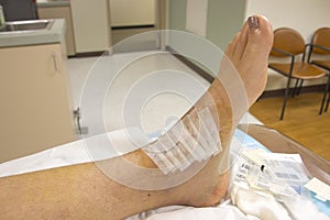 Bandages over stitches on human ankle