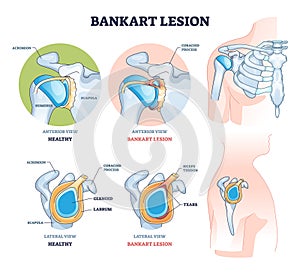 Bankart lesion as anterior part of the glenoid labrum trauma outline diagram