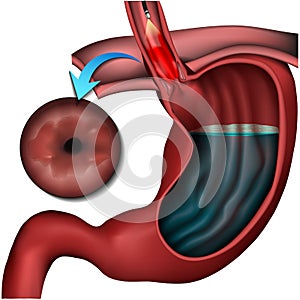 Barett esophagus disease medical  illustration on white background