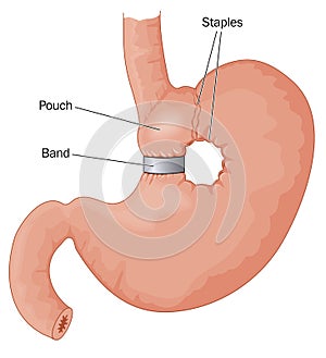 Bariatric surgery