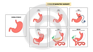 Bariatric surgery poster