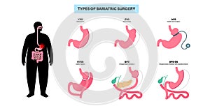 Bariatric surgery poster