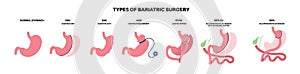 Bariatric surgery poster