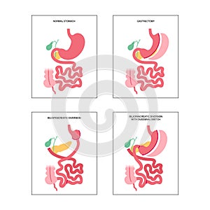 Bariatric surgery poster