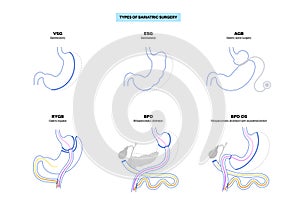 Bariatric surgery poster