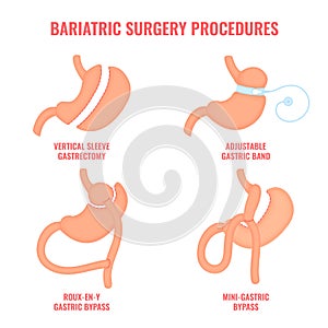 Bariatric surgery weight loss procedures medical infographics